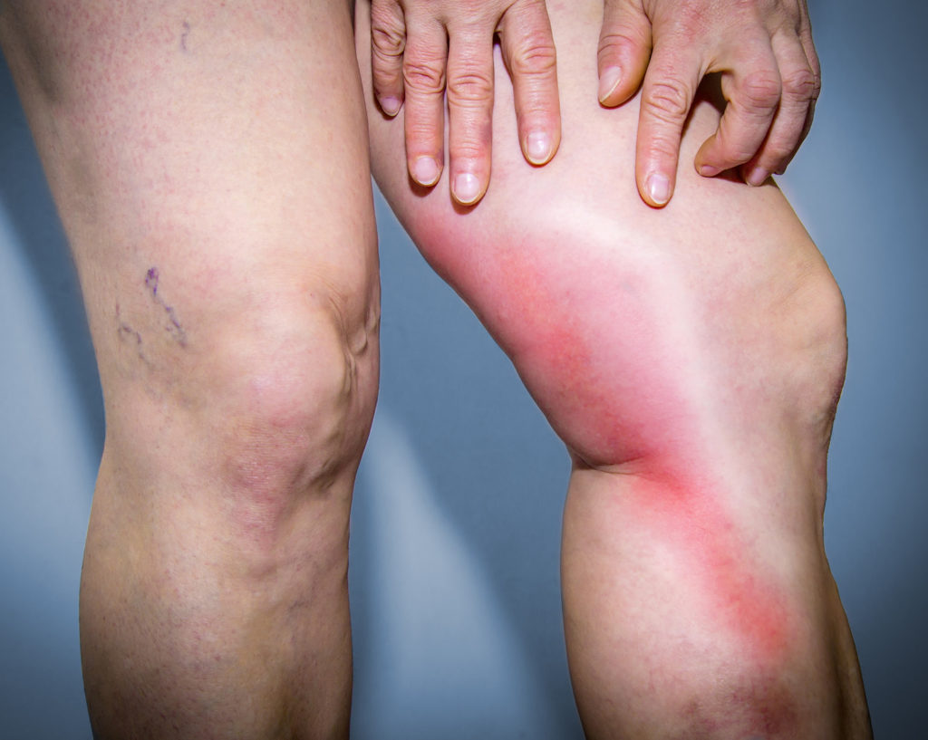 Superficial Phlebitis And Thrombophlebitis Causes Diagnosis Treatment