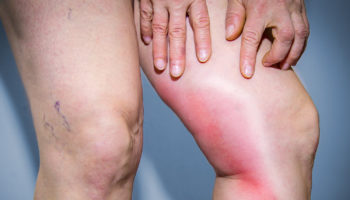 phlebitis