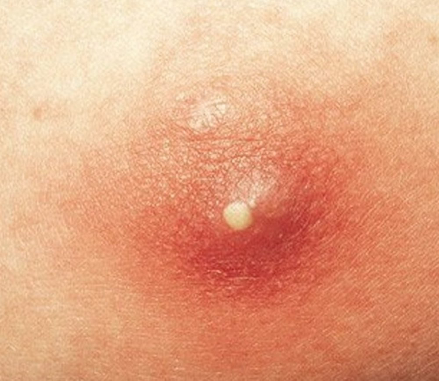 Brown Papules on the Penis | MDedge Dermatology