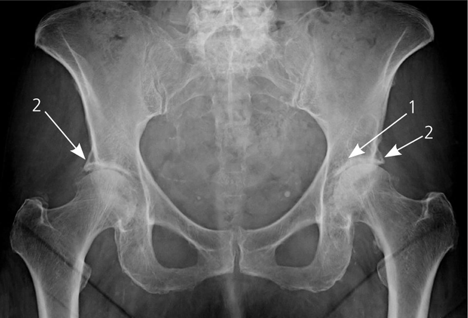 xray of normal hip joint vs osteoarthritic