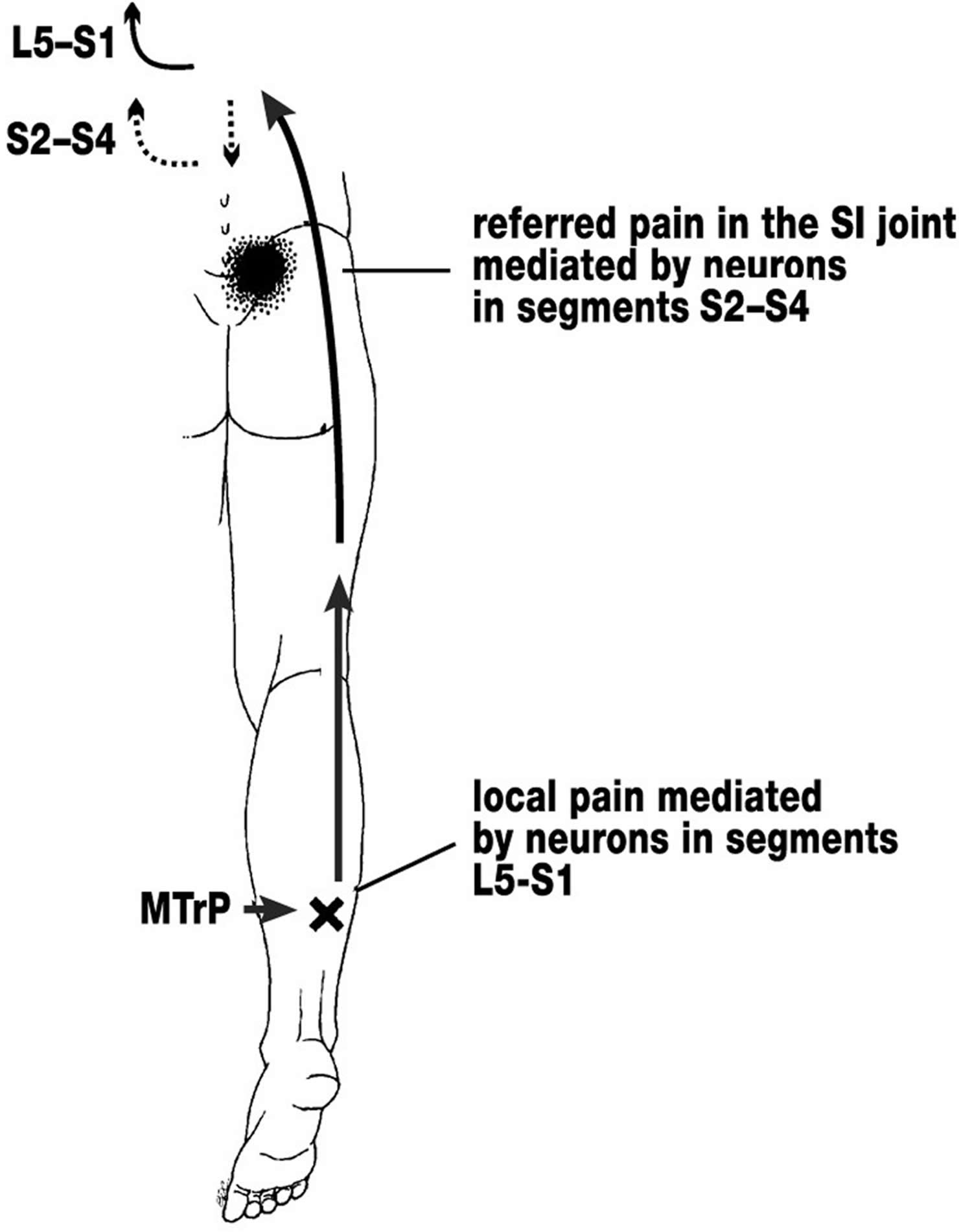 referred muscle pain