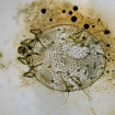 scabies