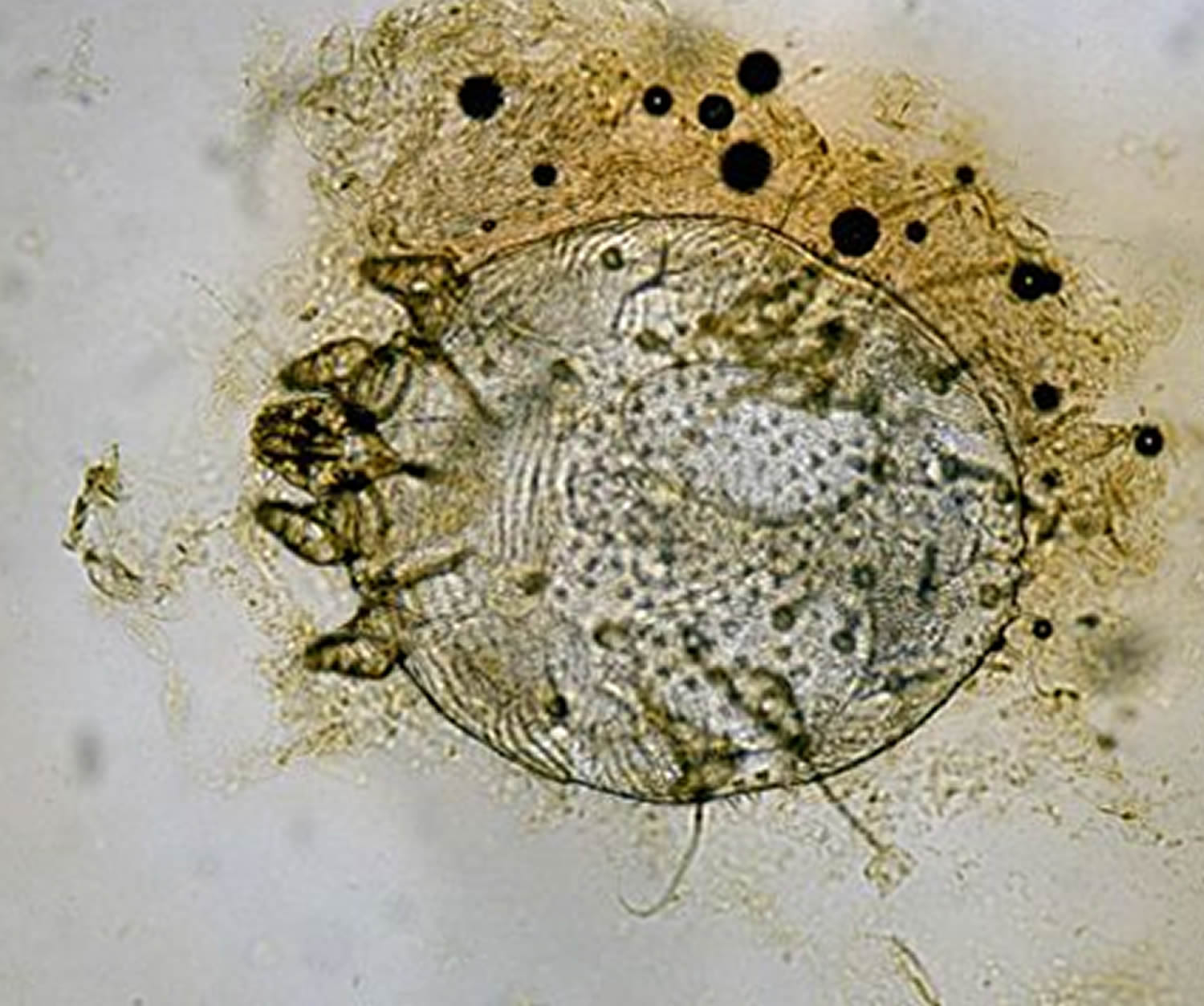 Scabies Images Under Microscope