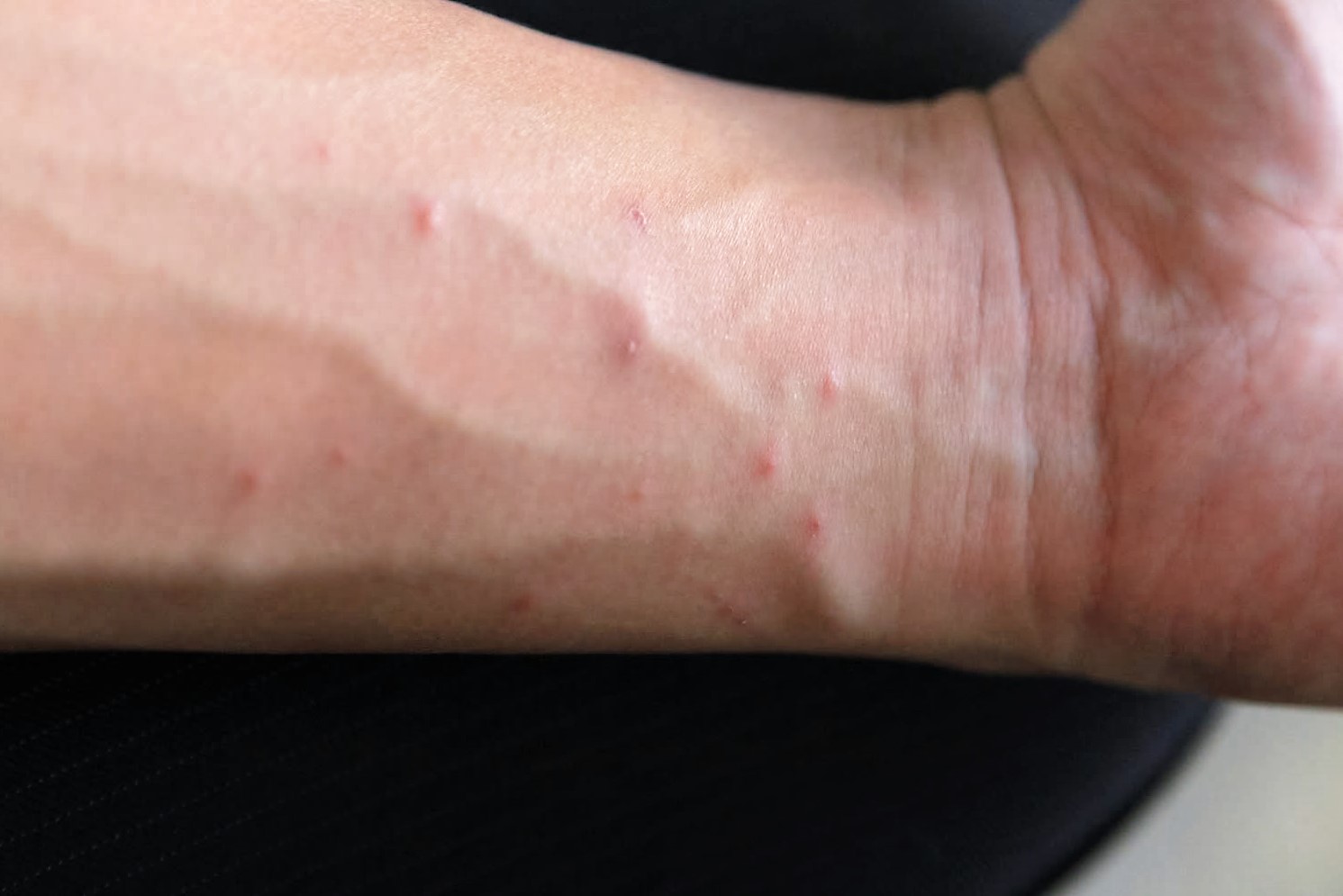 Scabies Signs, Symptoms, OTC Treatment & Home Remedies