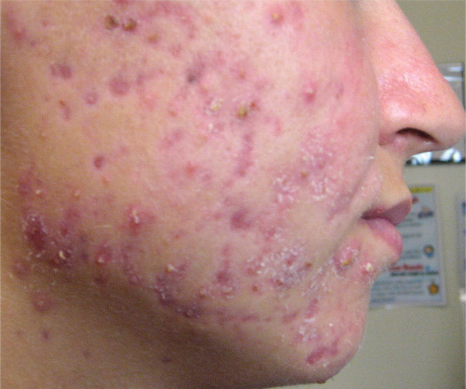 Acne Pimples Caises Best Treatment To Get Rid Of Acne And Pimples