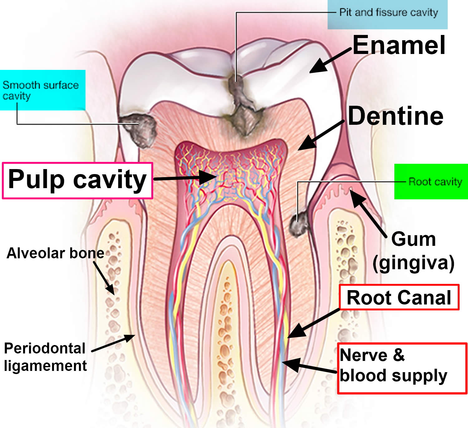 tooth cavity