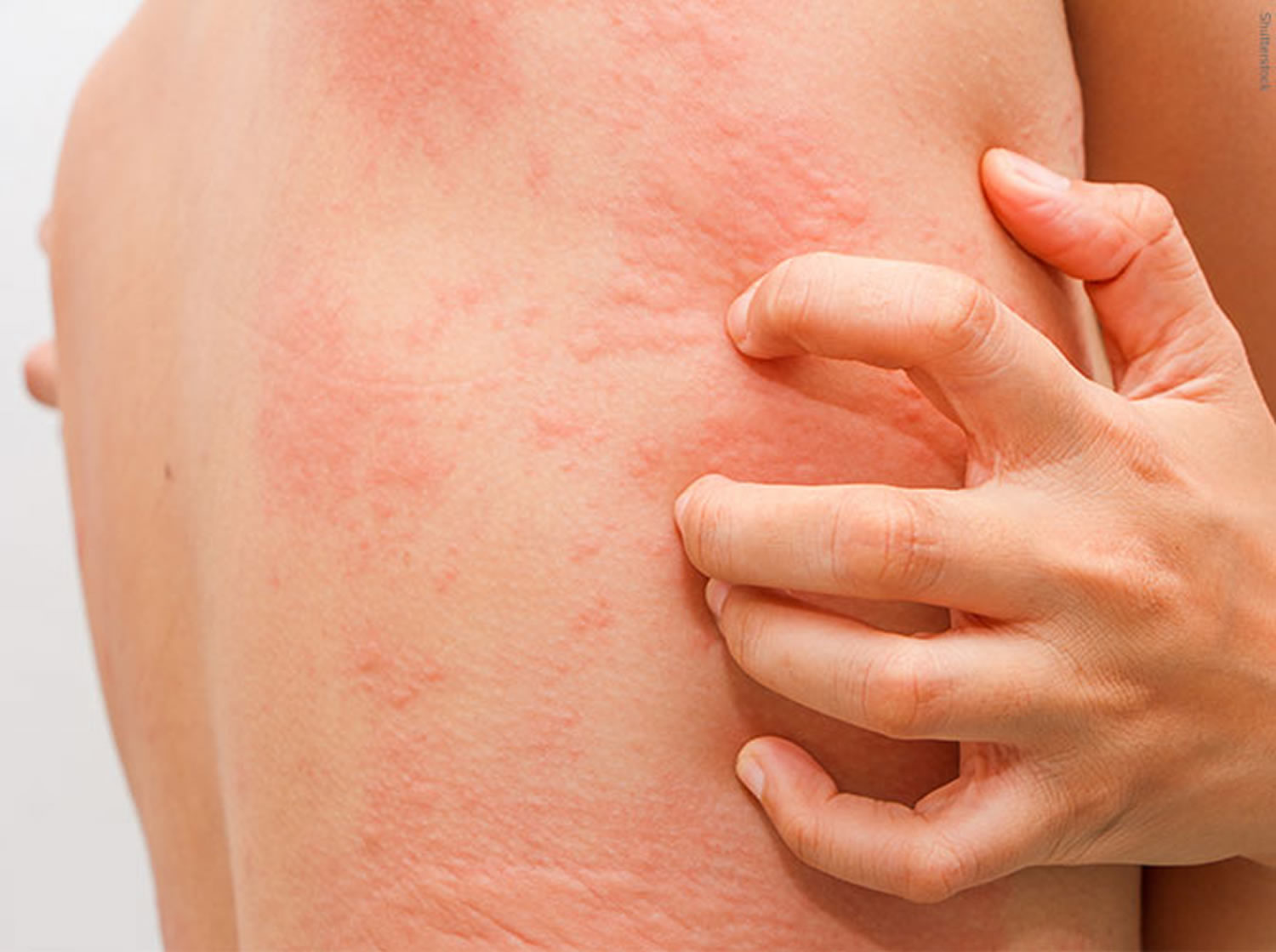 urticaria-causes-symptoms-treatment-home-remedies