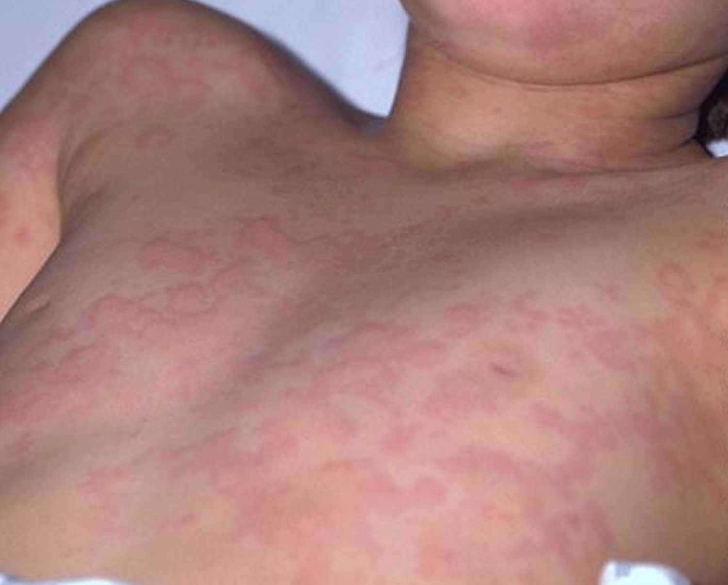 Urticaria Causes Symptoms Treatment Home Remedies