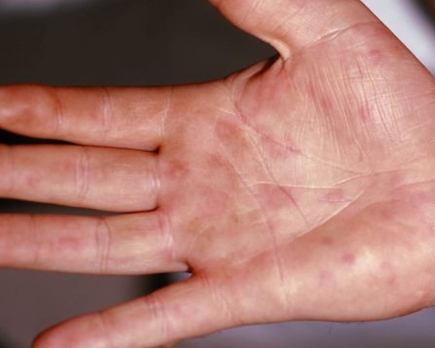 What causes hives on hands and legs