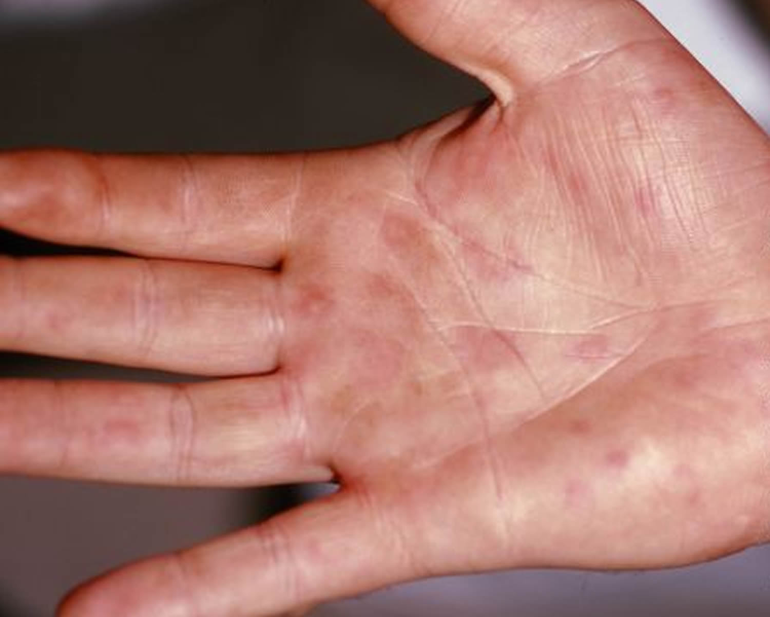 urticaria palm