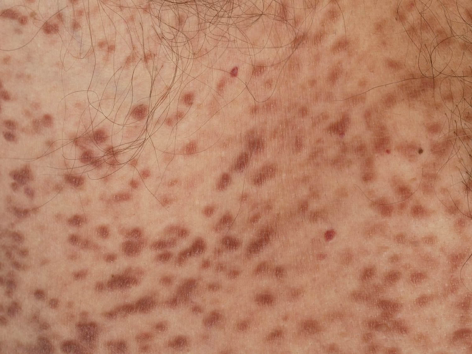 urticaria-pigmentosa