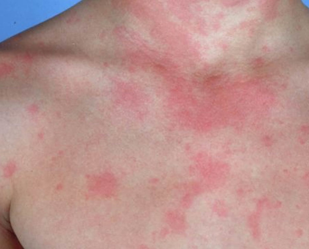 Urticaria - Causes, Symptoms, Treatment, Home Remedies