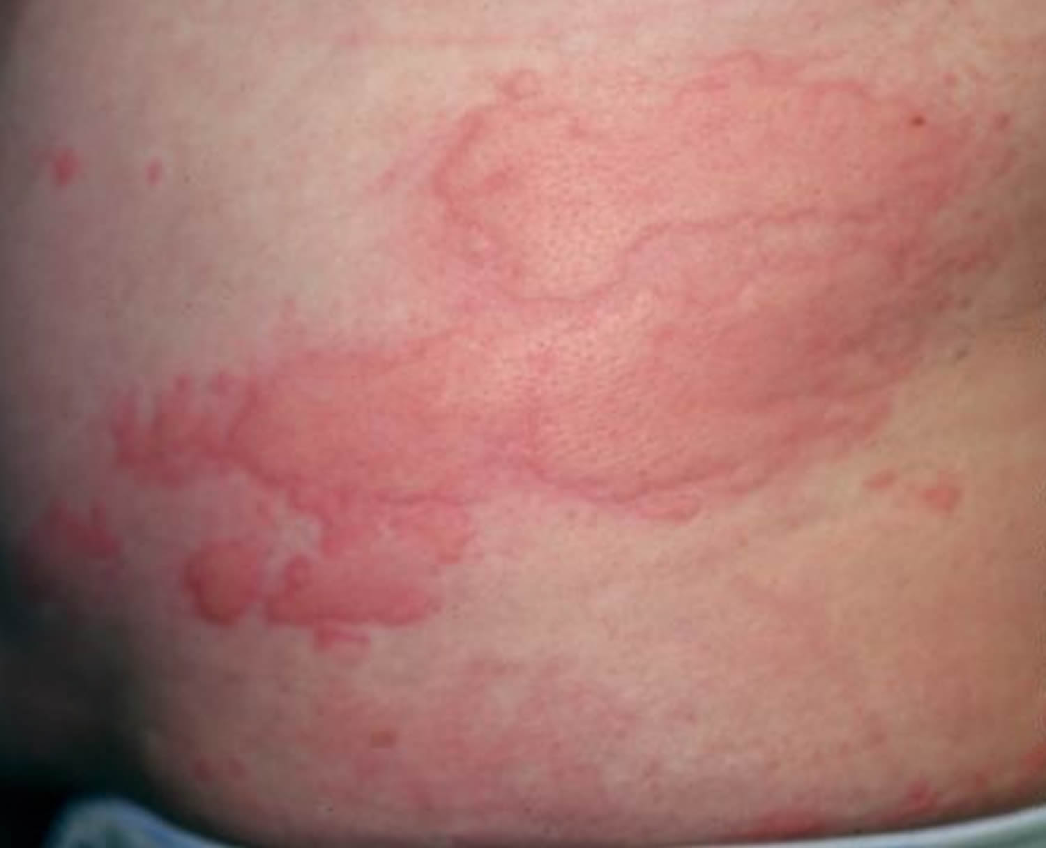 urticaria