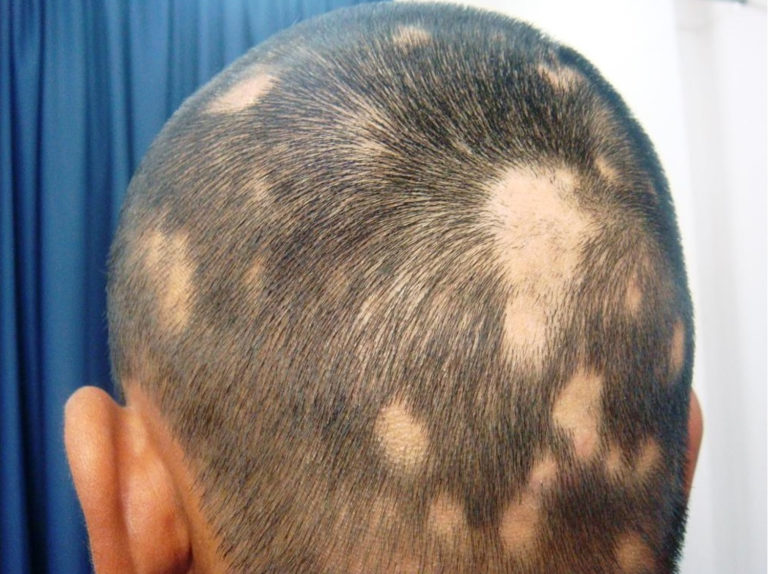 Hair Loss In Women & Men - Causes, Diagnosis & Hair Loss Treatment