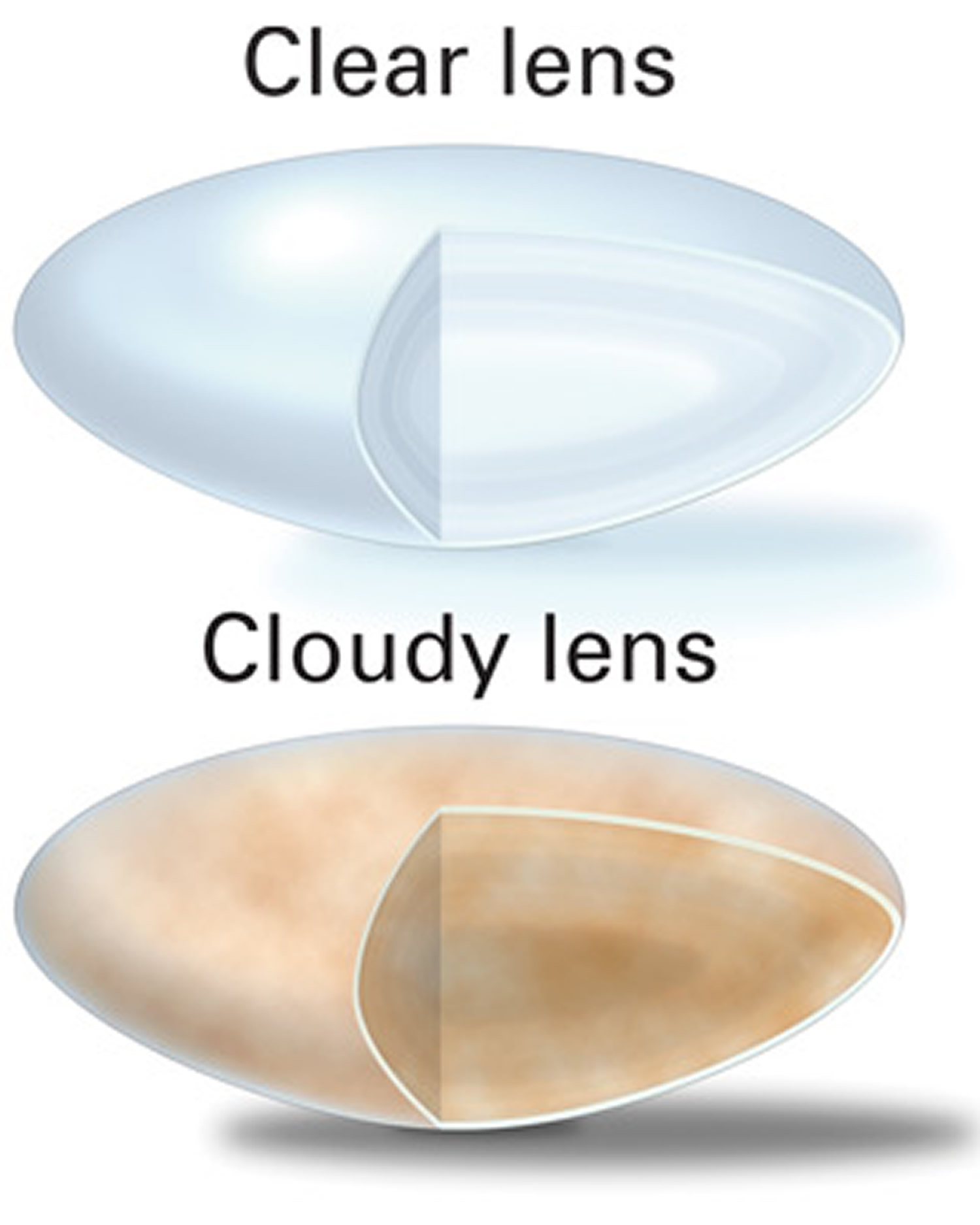 Clear-and-Cloudy-Lenses