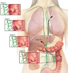 colon cancer early stages