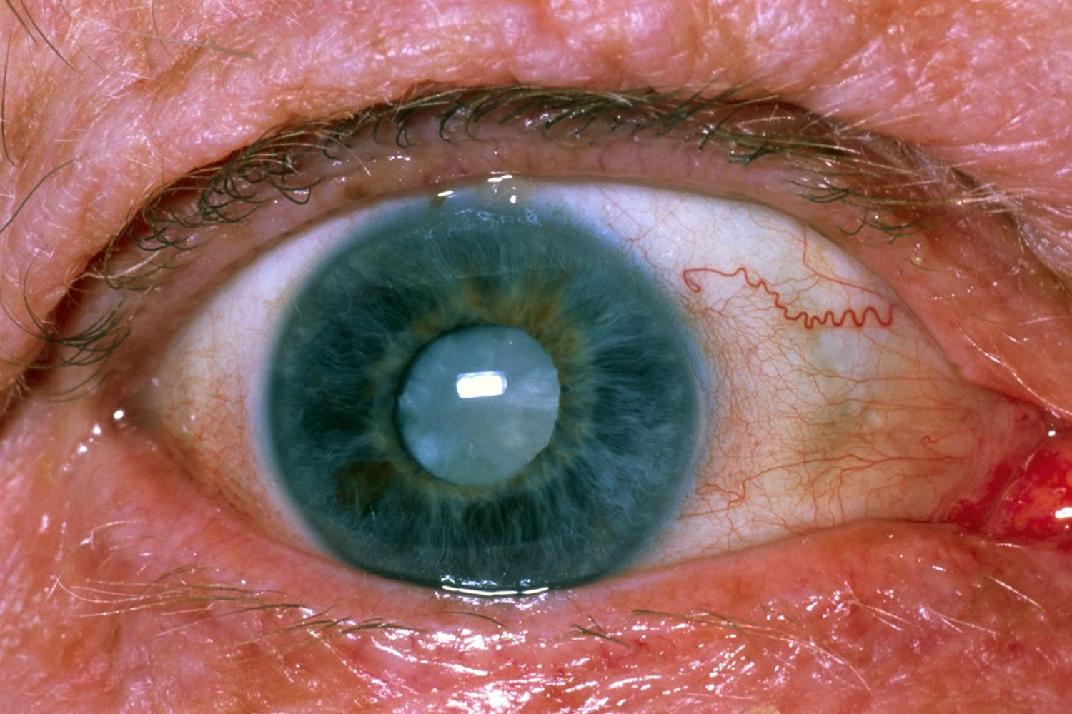 Eye cataract