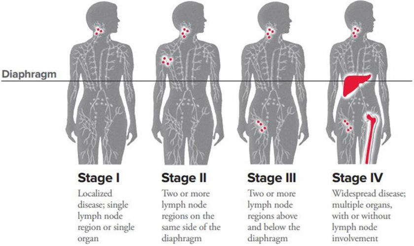 Lymphoma - Hodgkin & Non-Hodgkin Lymphoma - Survival Rate