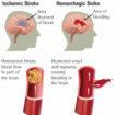 Ischemic Stroke - Causes, Signs, Symptoms & Ischemic Stroke Treatment