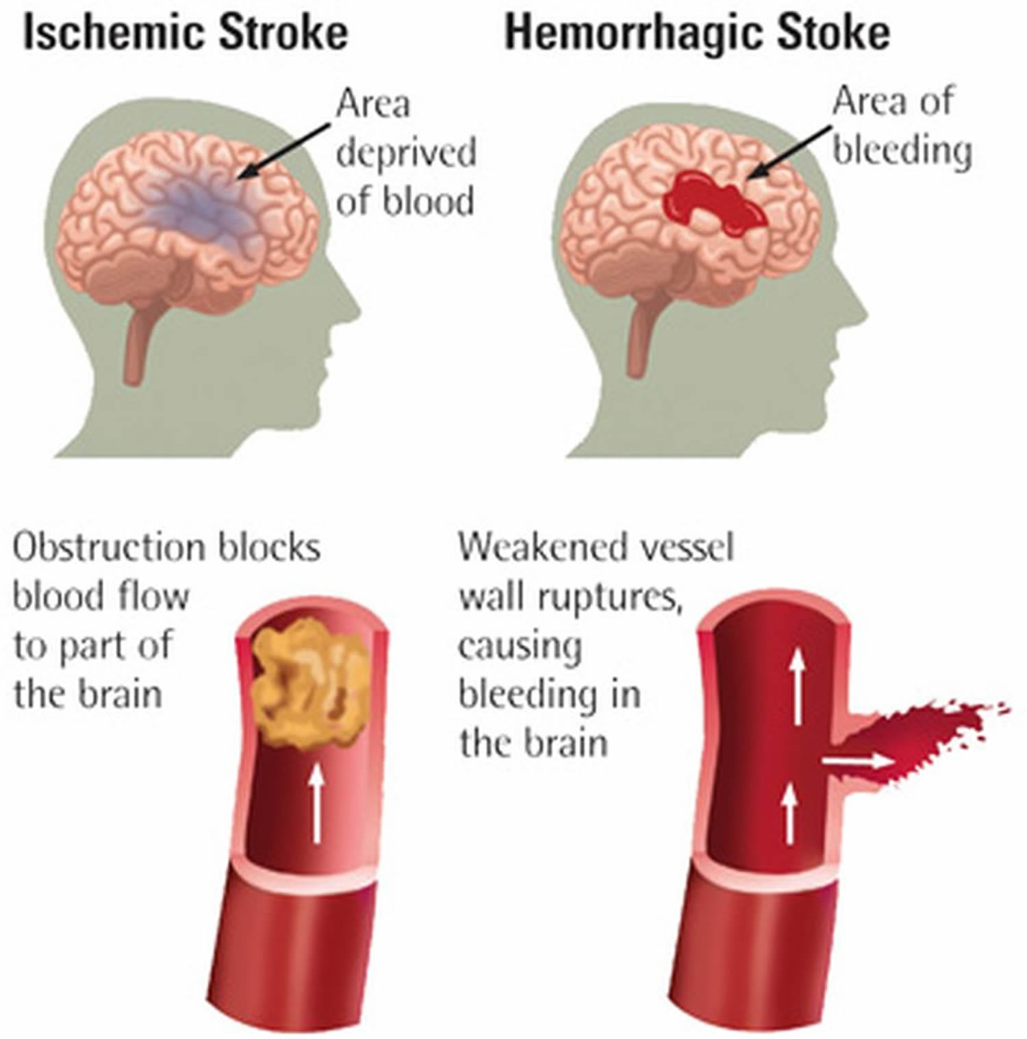 Ischemic stroke vs Hemorrhagic stroke