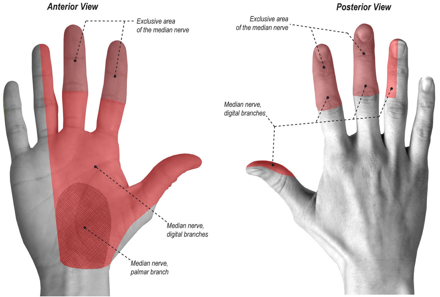 Carpal Tunnel Syndrome - Causes, Treatment, Splint & Surgery