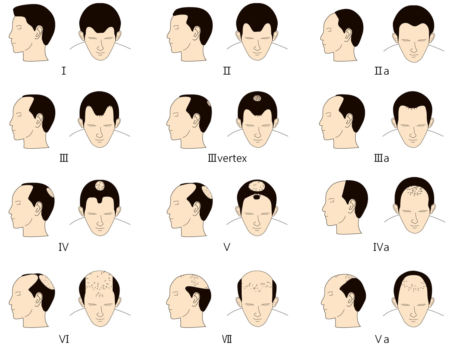 Hair Loss In Women And Men Causes Diagnosis And Hair Loss Treatment 1989