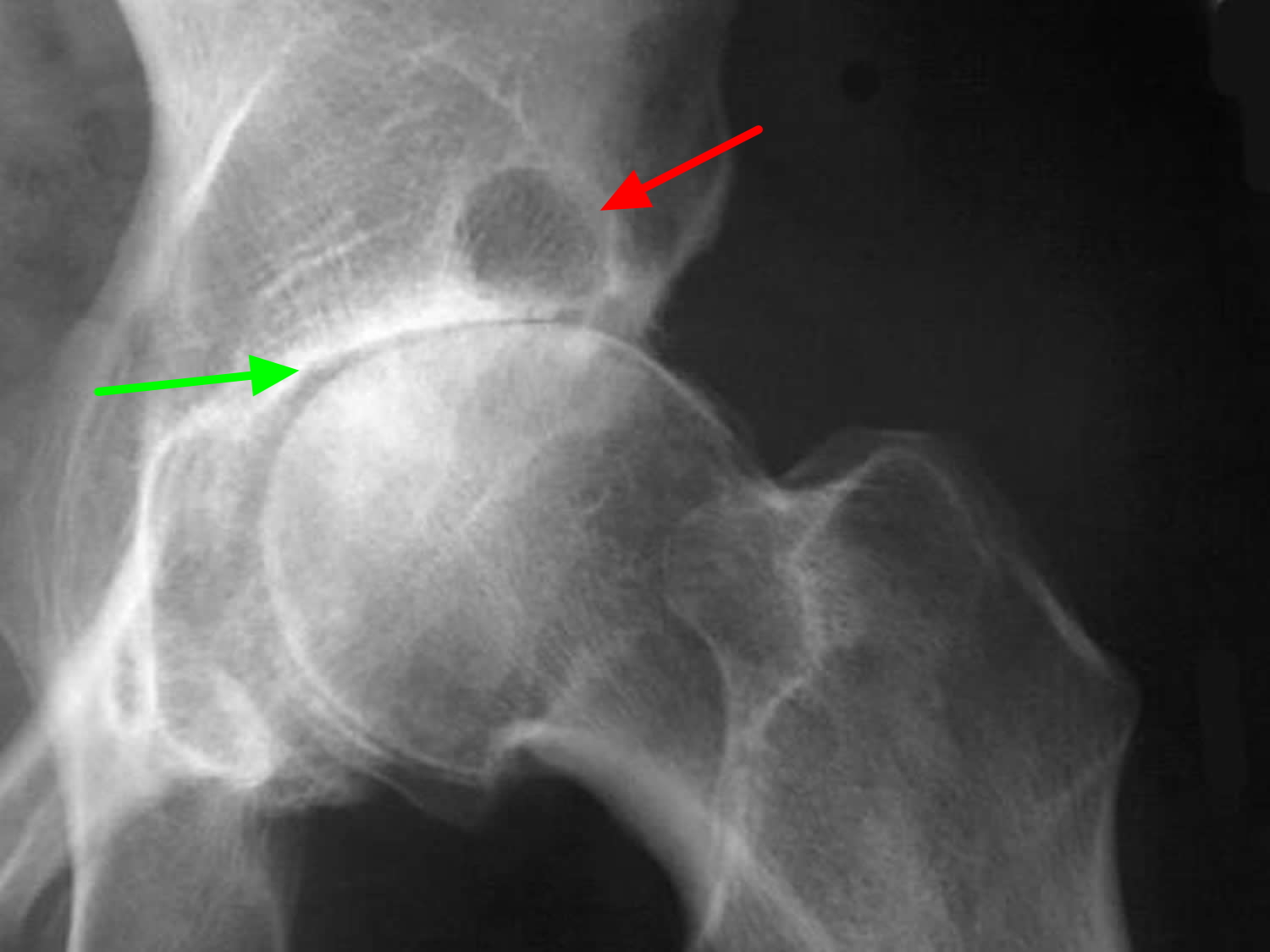 Xray of normal hip joint vs osteoarthritic - stationlity