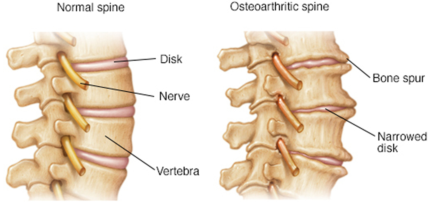 Osteoarthritis Causes, Symptoms, Diagnosis, Prognosis & Treatment