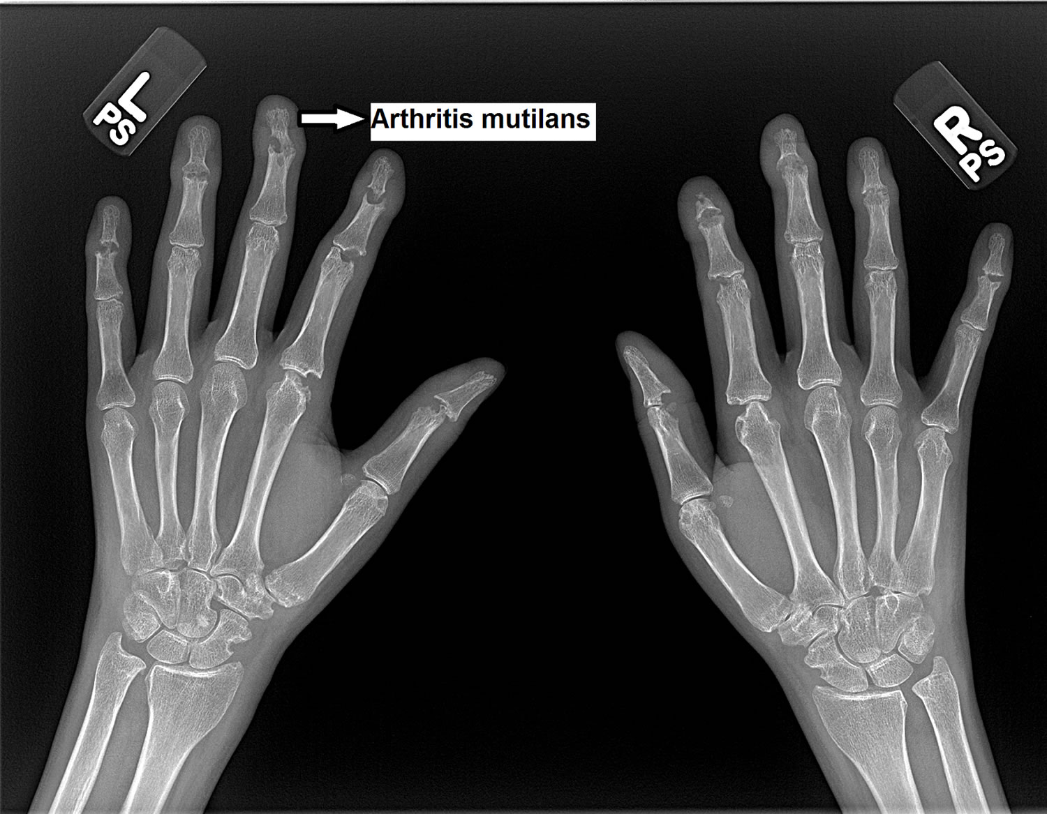 Psoriatic Arthritis Mutilans