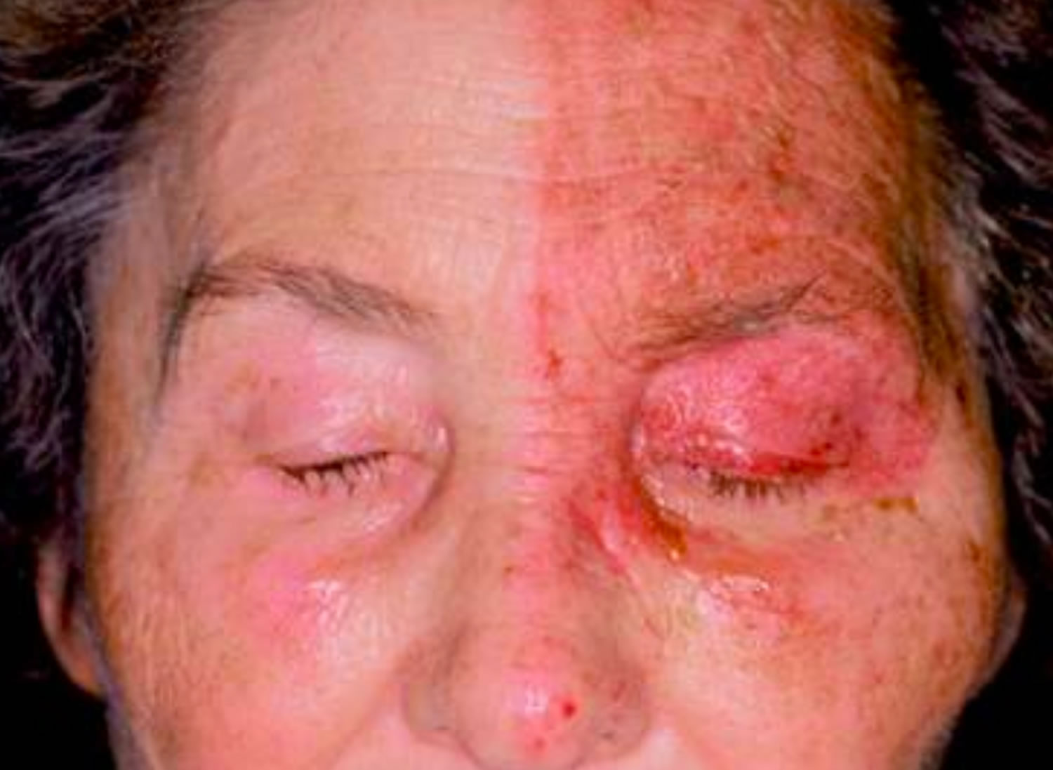 mild shingles on face