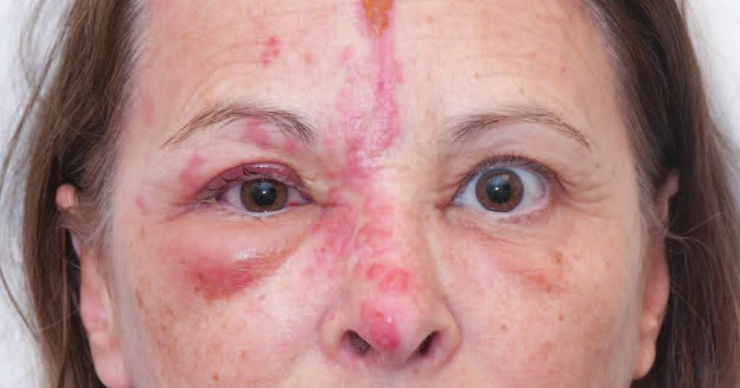 mild shingles on face