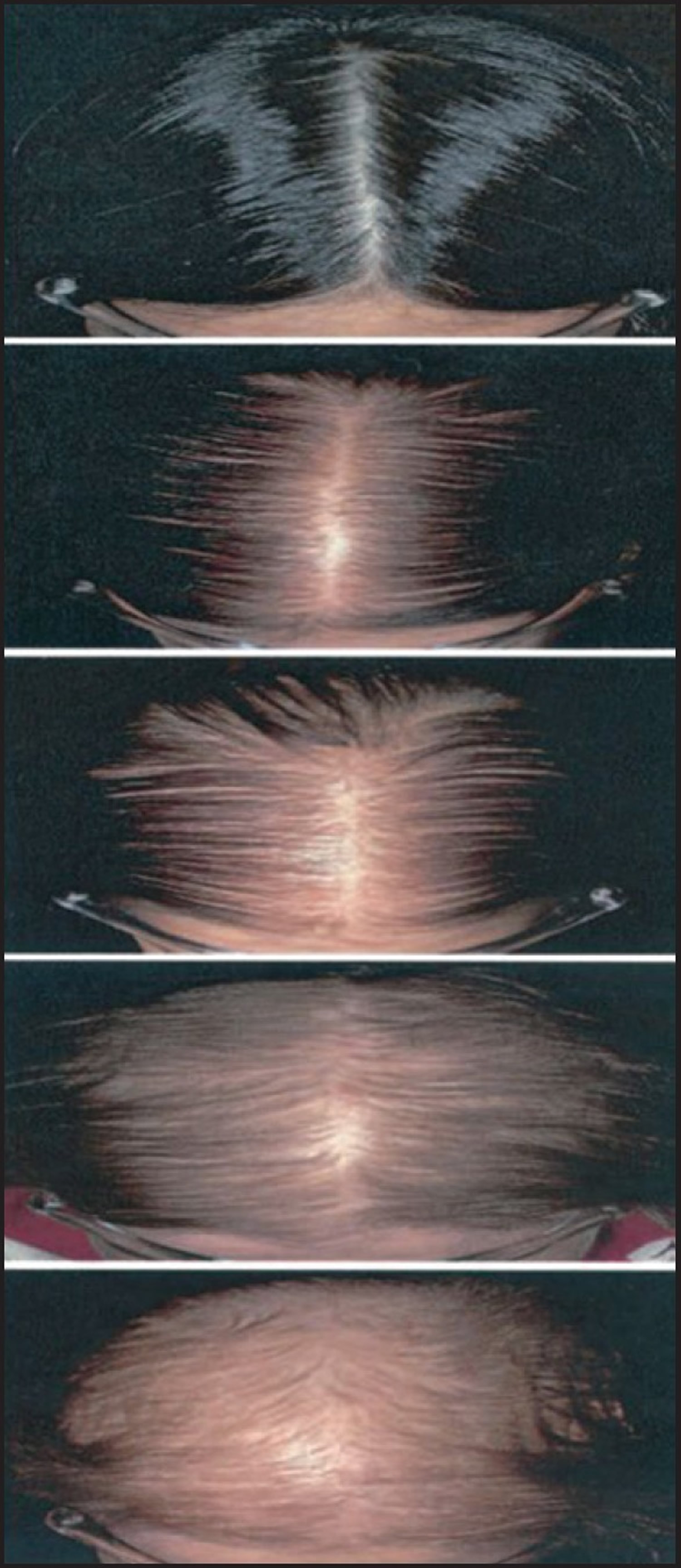 Hair Loss In Women & Men - Causes, Diagnosis & Hair Loss Treatment