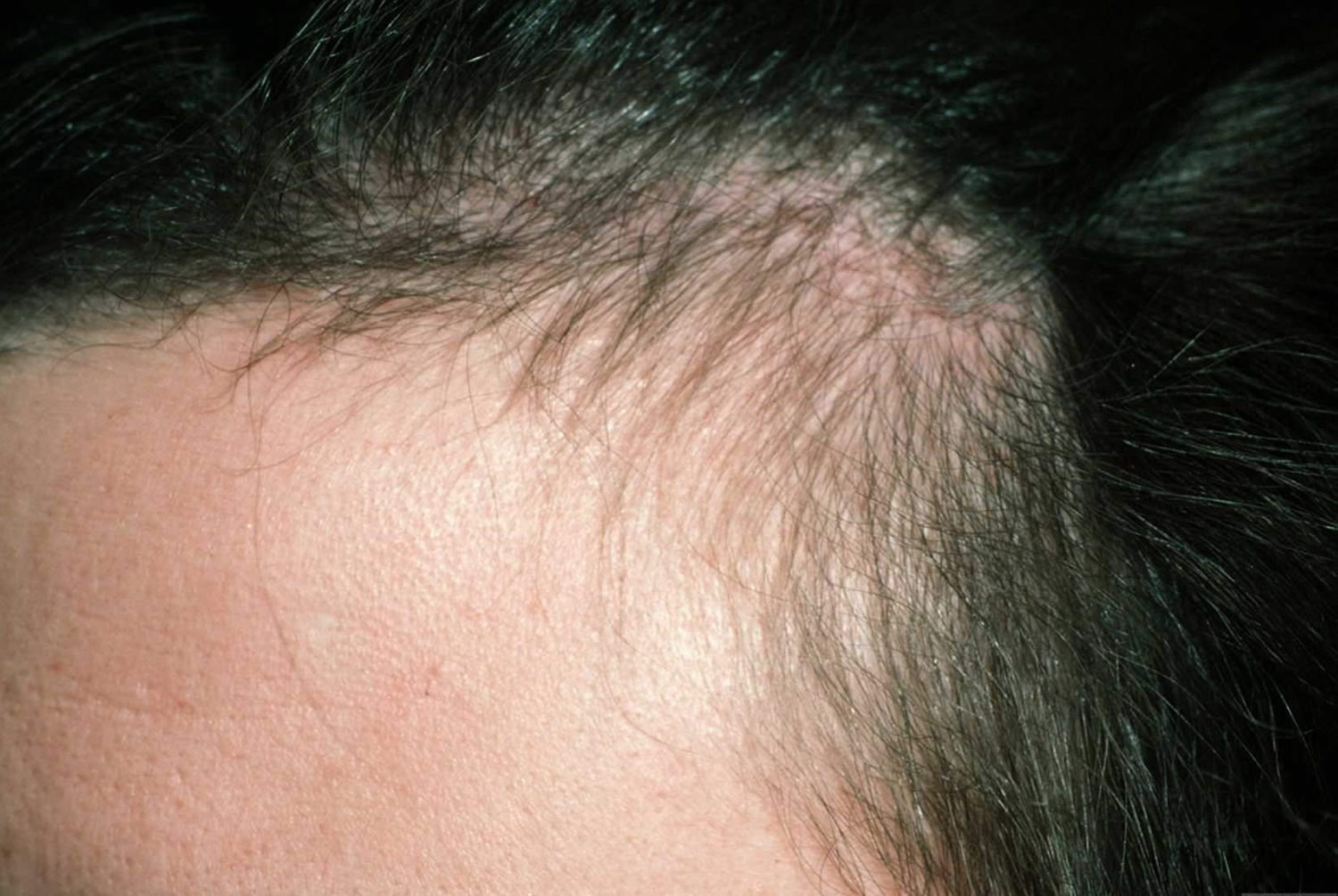 Hair Loss In Women & Men - Causes, Diagnosis & Hair Loss 