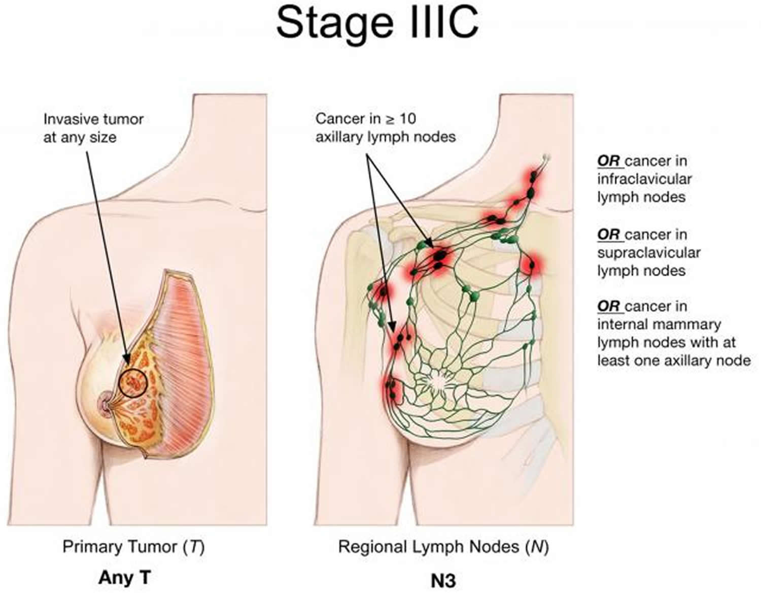 Breast Cancer Causes Signs Symptoms Types Treatment