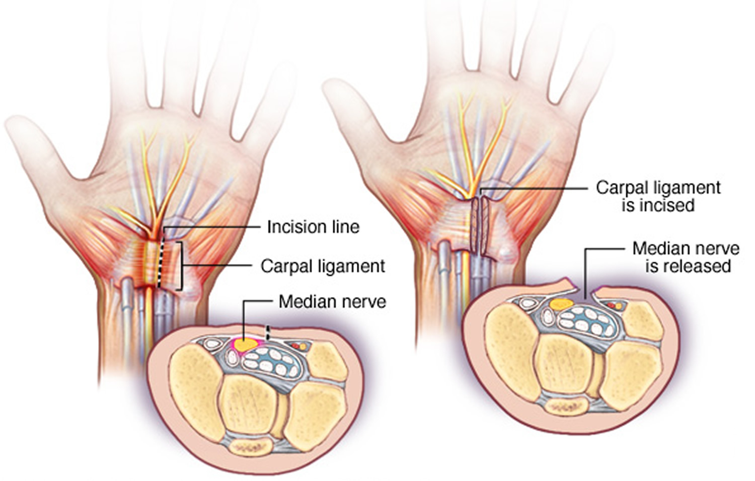 carpal-tunnel-syndrome-causes-treatment-splint-surgery