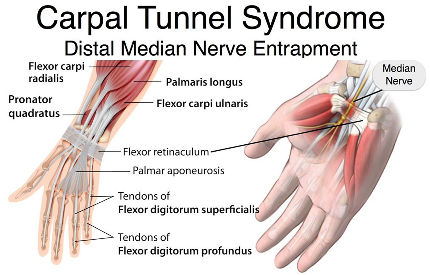 carpal-tunnel-syndrome-causes-treatment-splint-surgery