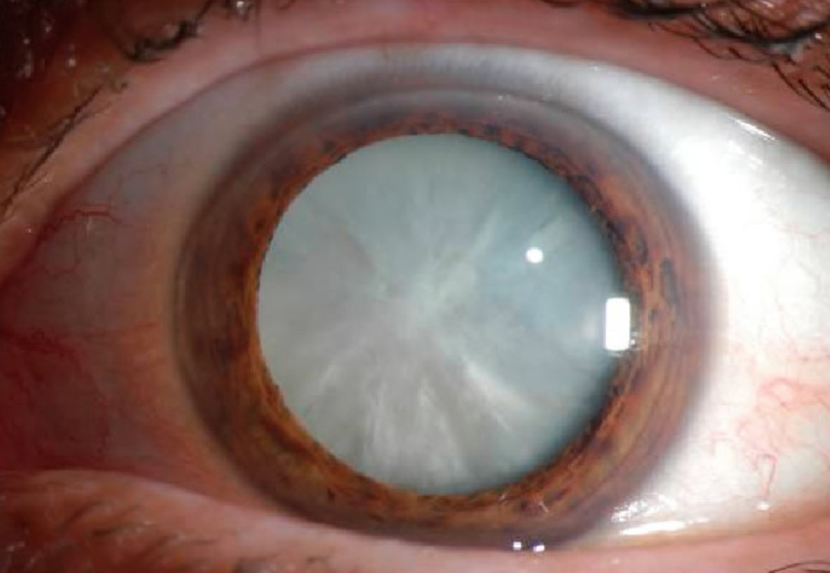 cataracts-causes-signs-symptoms-surgery-recovery-complications