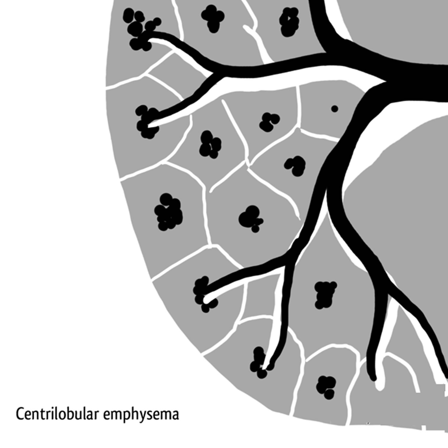 centrilobular emphysema