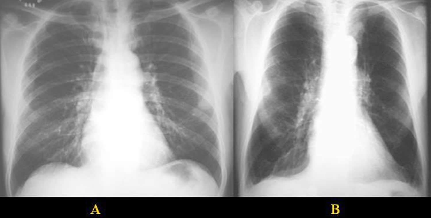 chest radiograph - normal and emphysema