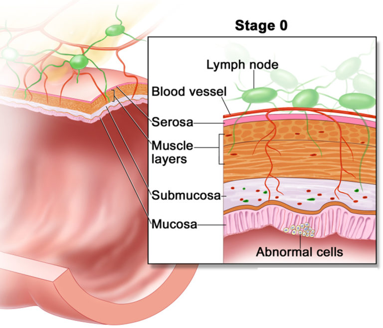 Colon Cancer Causes, Signs, Symptoms, Stages, Screening & Treatment