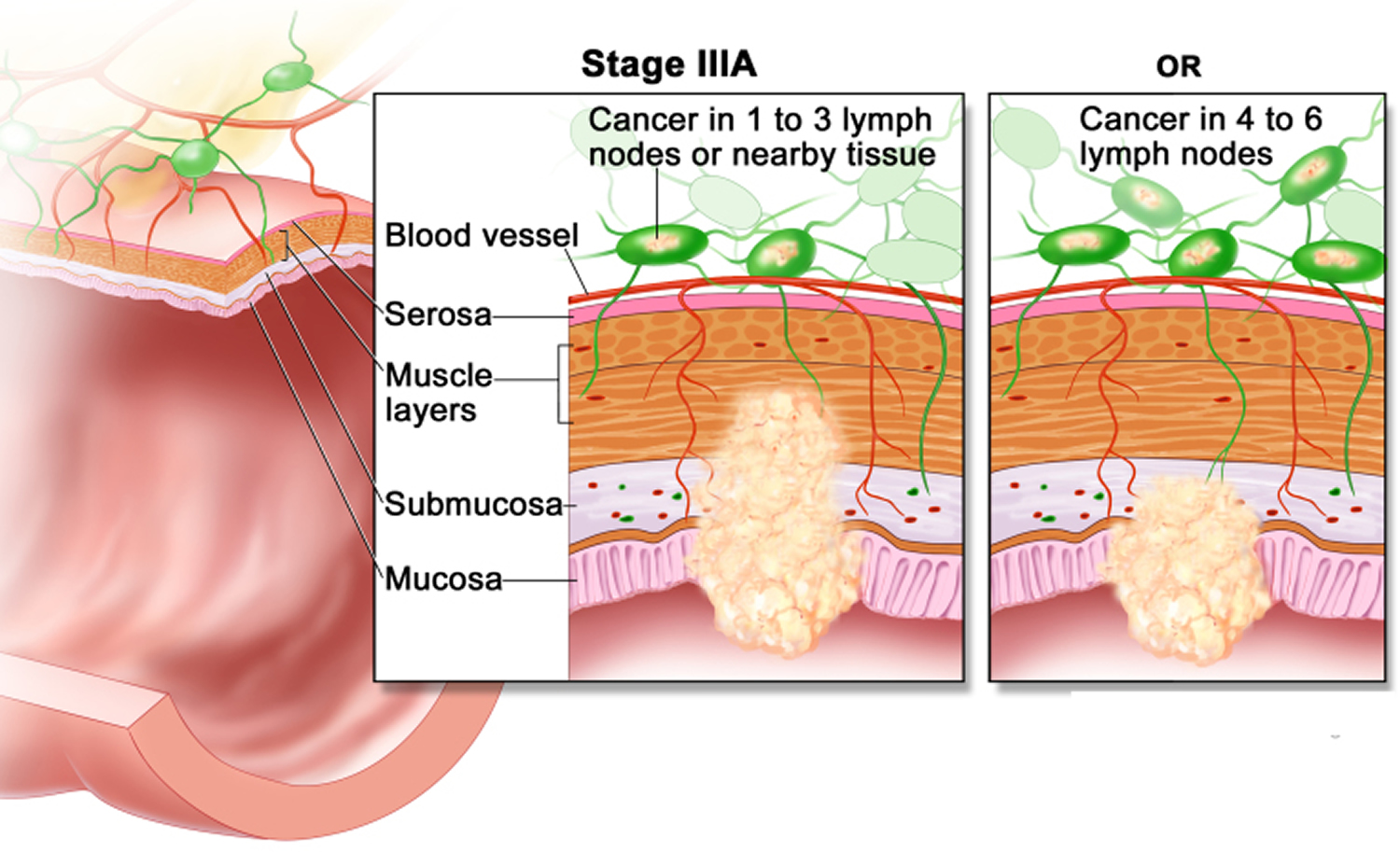 Colon Cancer Causes, Signs, Symptoms, Stages, Screening ...