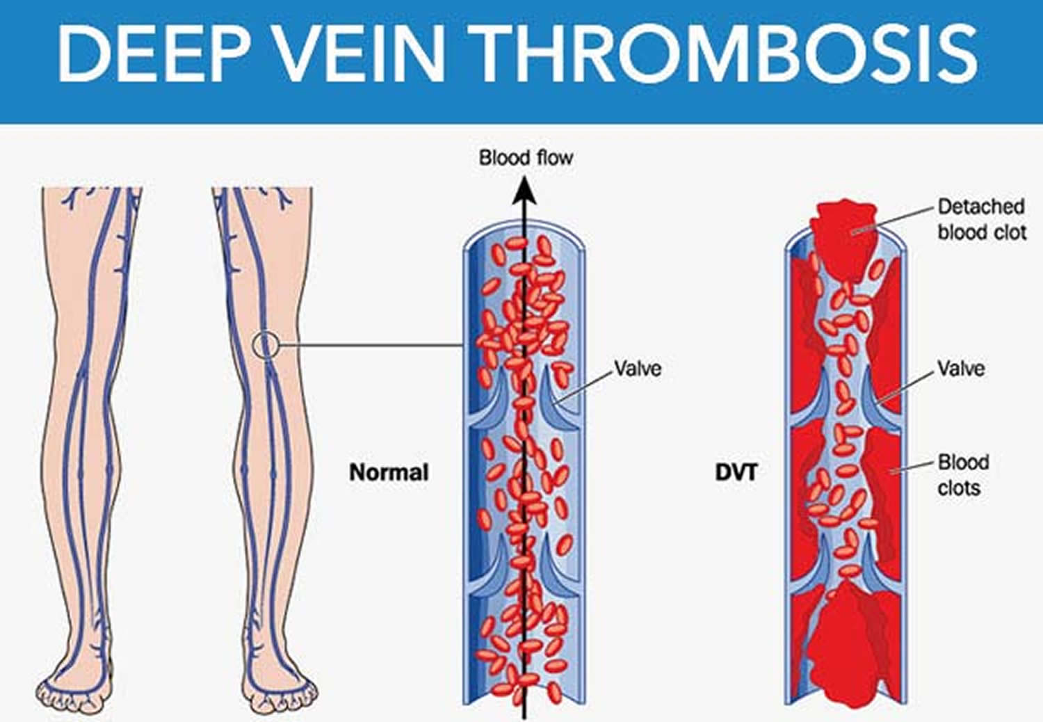 DVT Deep Vein Thrombosis Signs, Symptoms, Prophylaxis & Treatment