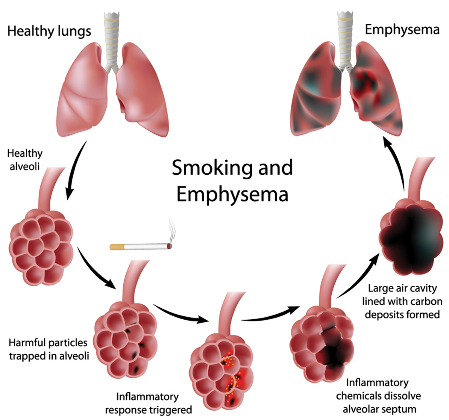 emphysema