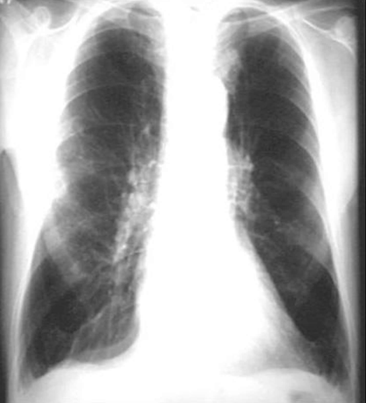emphysema chest x-ray