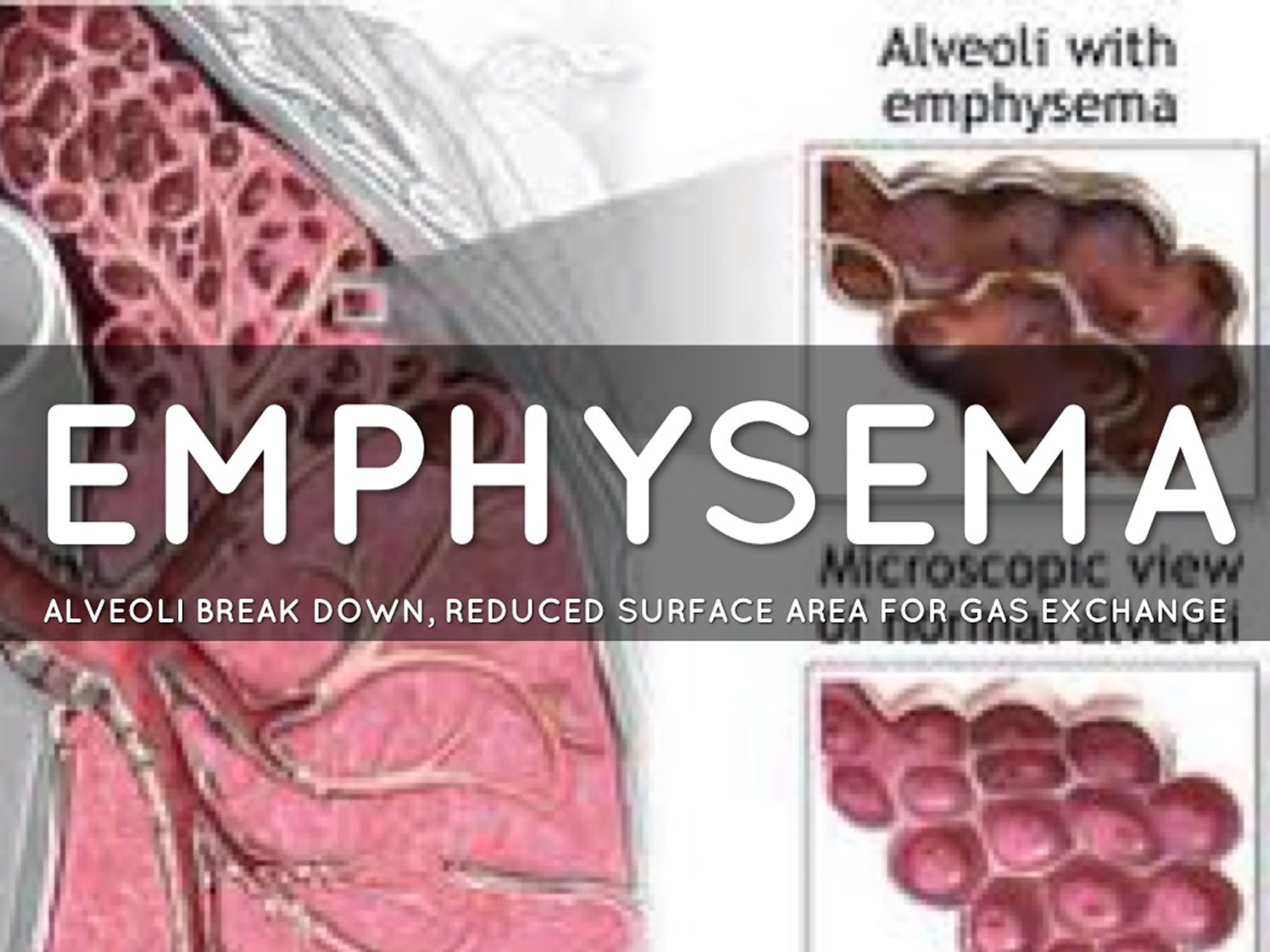 Emphysema - Causes, Signs, Symptoms, Stages, Expectancy 