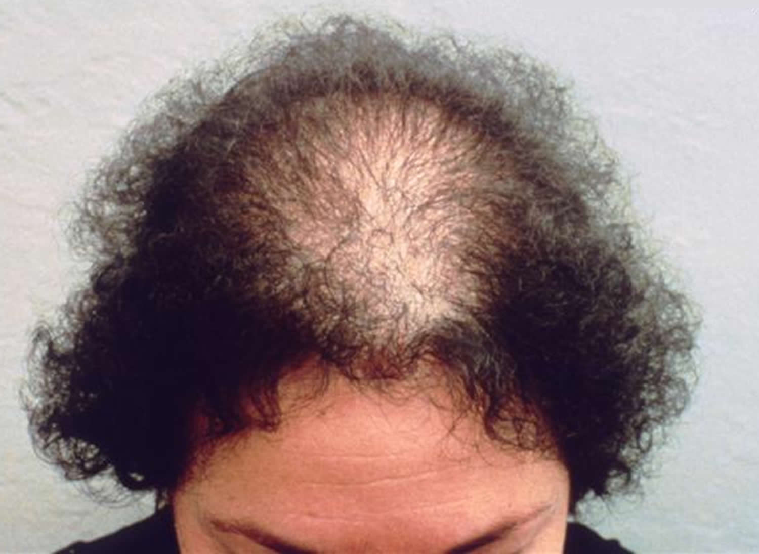 hair loss hair loss