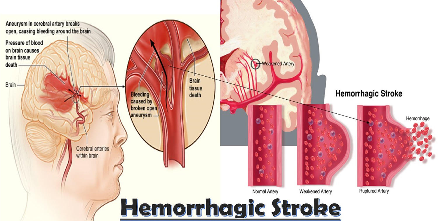 hemorrhagic stroke