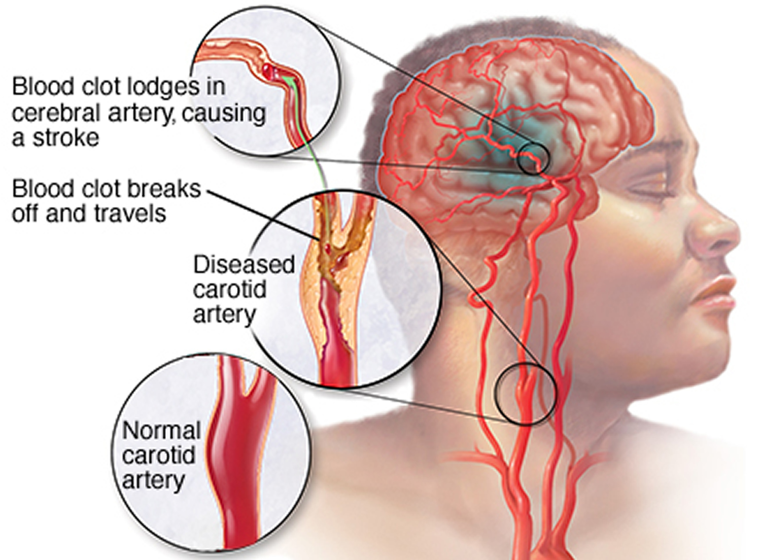 presentation of ischemic stroke