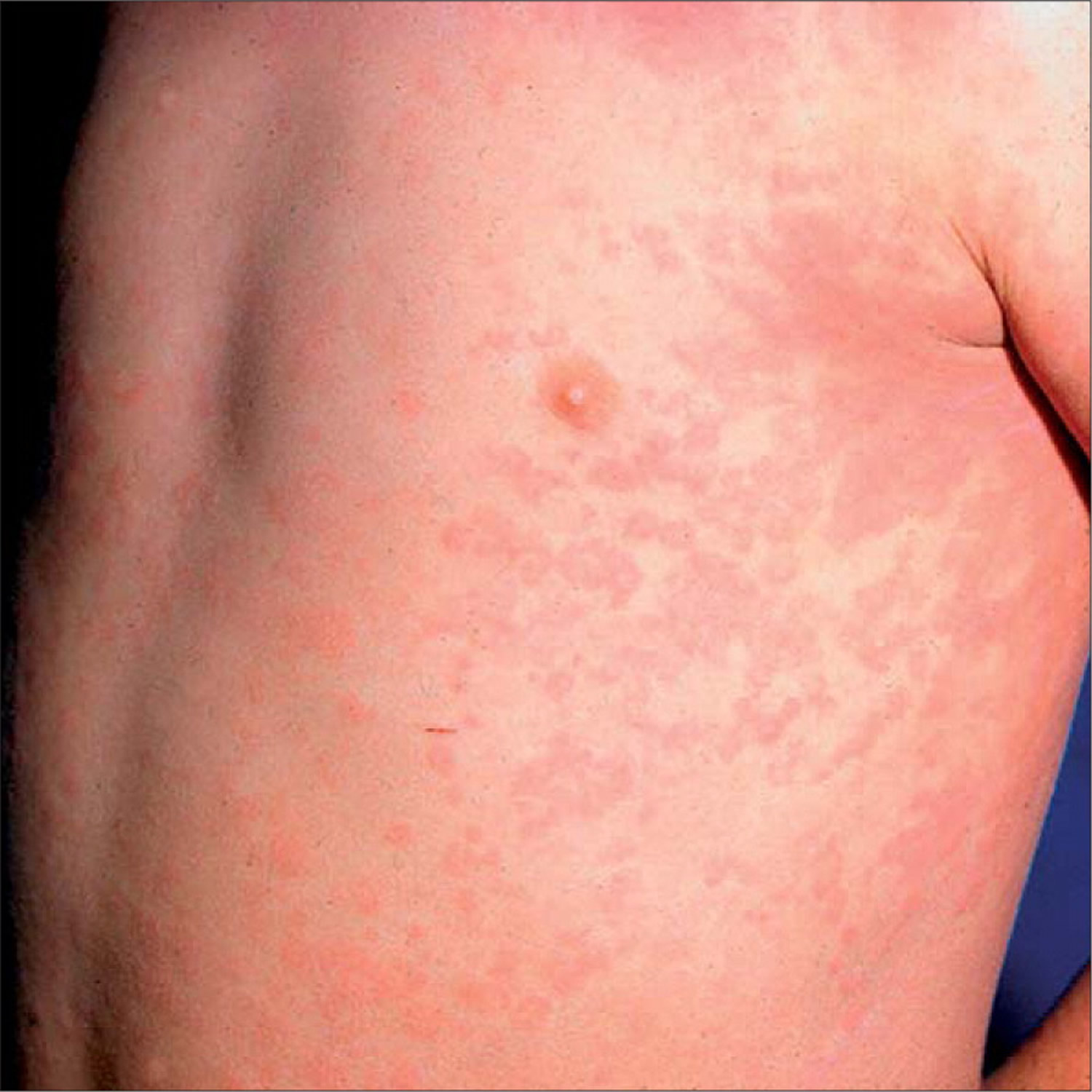 Juvenile Rheumatoid Arthritis Rash 