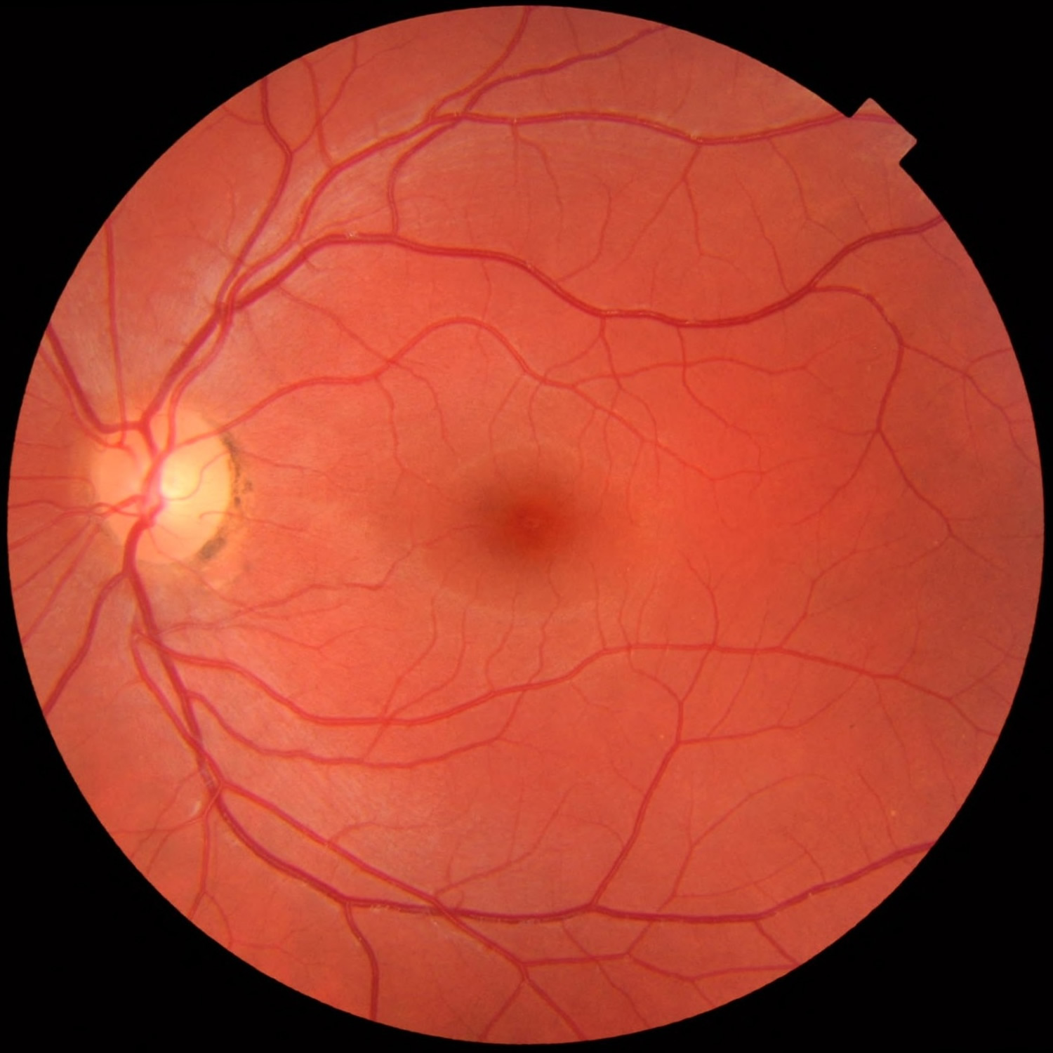 normal retina